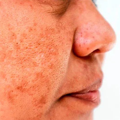 Tratamiento para el Melasma